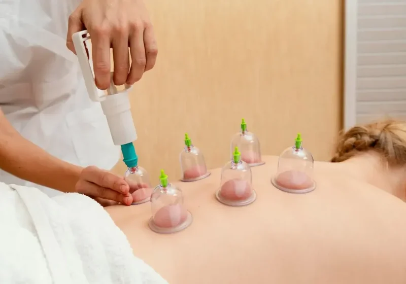 Cupping session at Action Rehab Physical Therapy in Honolulu